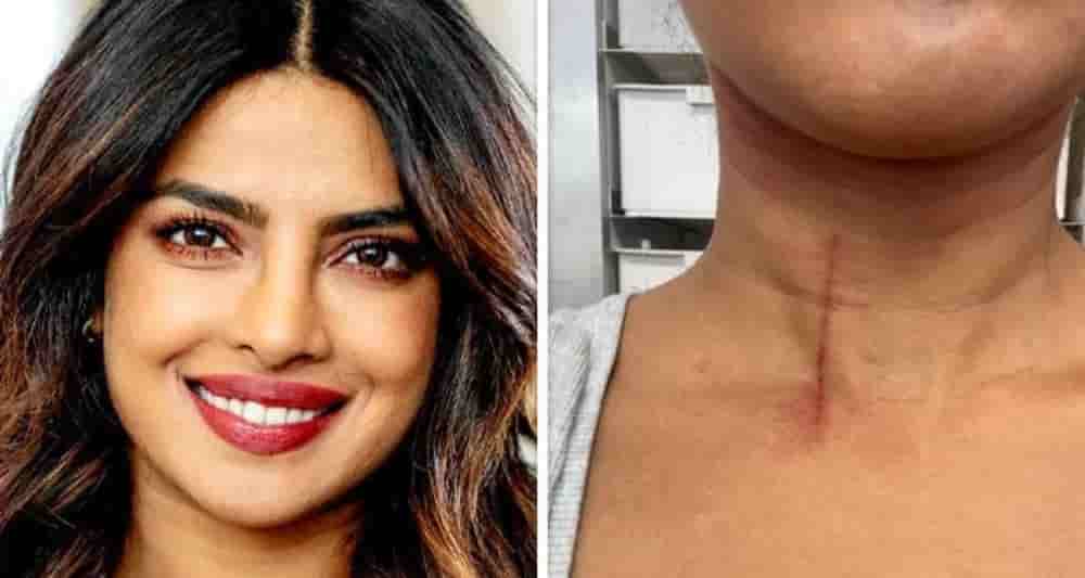 priyanka chopra injury